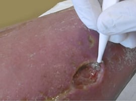 Chirurgisches Débridement mit einer Ringkürette