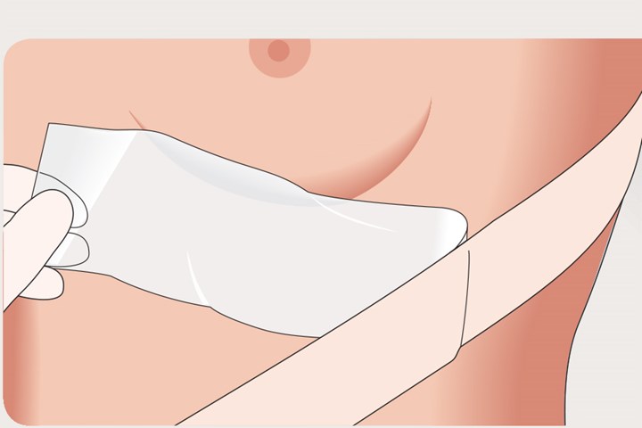 Mepiform Anwendung Schritt&nbsp;2