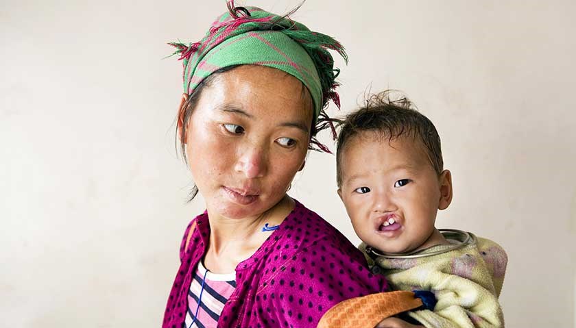 A Operation Smile oferece às crianças com deformidades faciais um novo começo